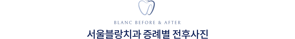 서울블랑치과의원 치료전후