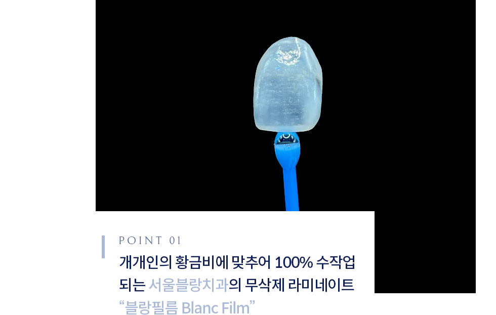 서울블랑치과의 무삭제 라미네이트