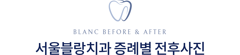 서울블랑치과의원 치료전후