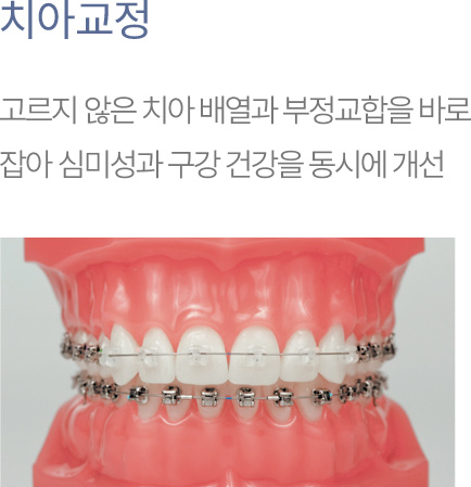 치아교정